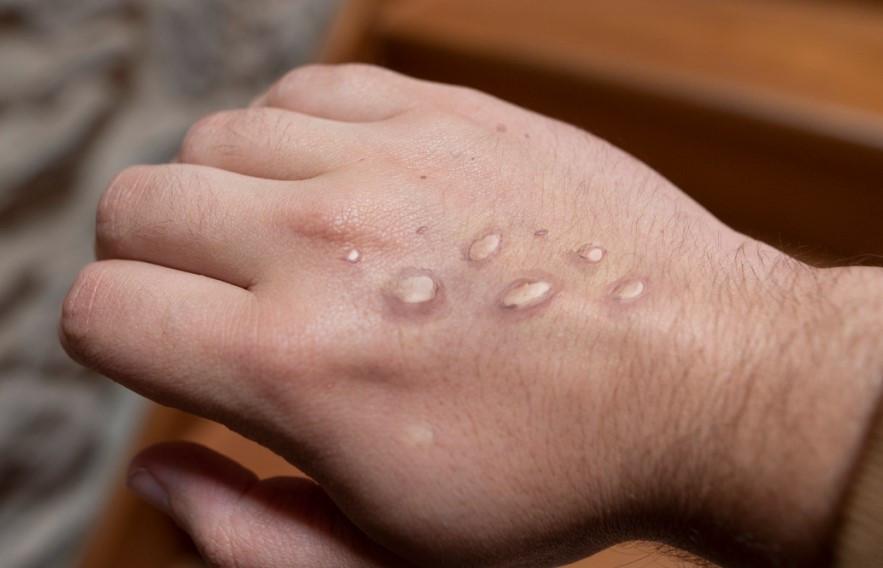 Varíola dos macacos: O que já sabemos sobre a transmissão e gravidade da doença