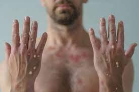Campinas confirma mais sete casos de monkeypox e soma 27 infectados